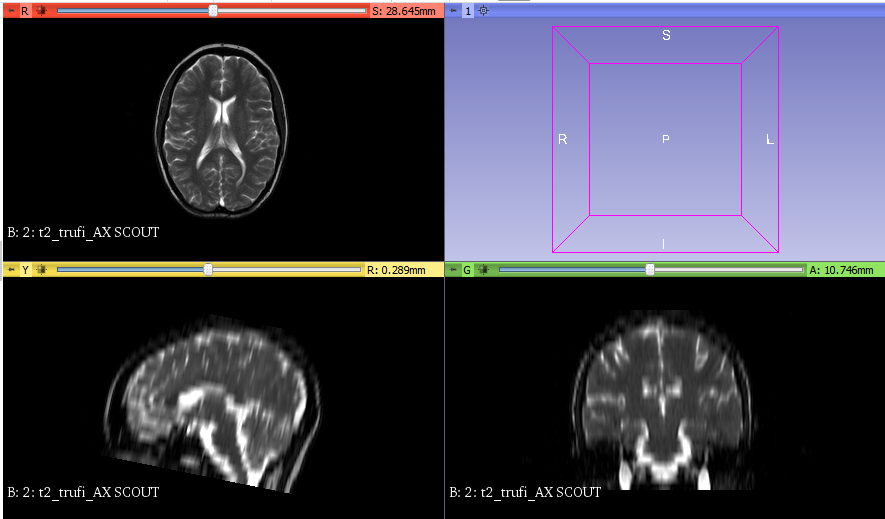 Brain MRI views in 3D Slicer for AVM segmentation